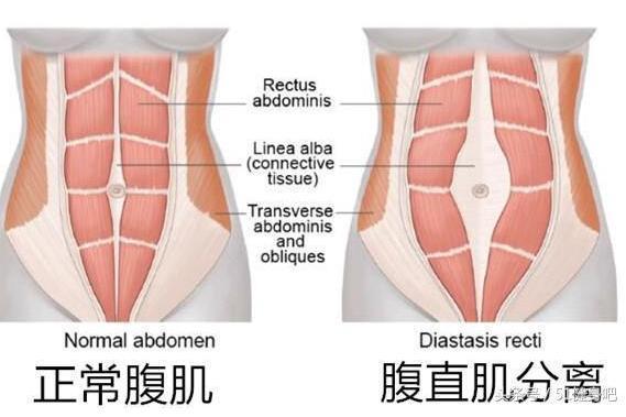 腹直肌分離