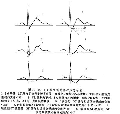 隱匿型冠心病的診斷