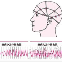 肌陣攣-站立不能性癲癇