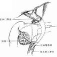 下腔靜脈成形術