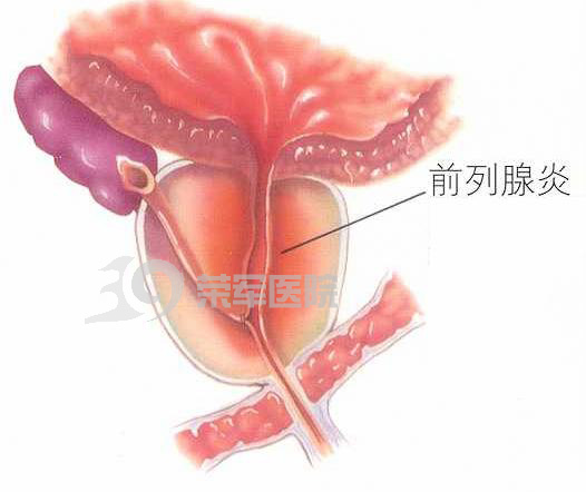 淋病合併症前列腺炎