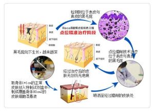 點位精準治療