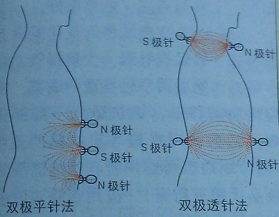 雙極磁鍉針