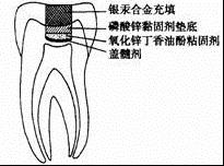 蓋髓術