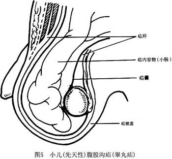 嬰兒腹股溝斜疝