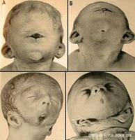 Fetal alcohol syndrome