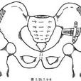 髂骨截骨延長術