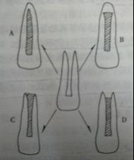 根尖誘導成形術