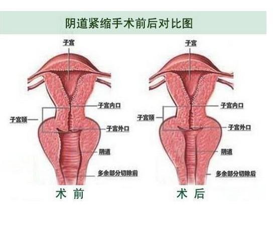 縮陰術