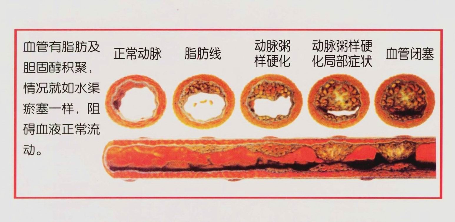 血管硬化