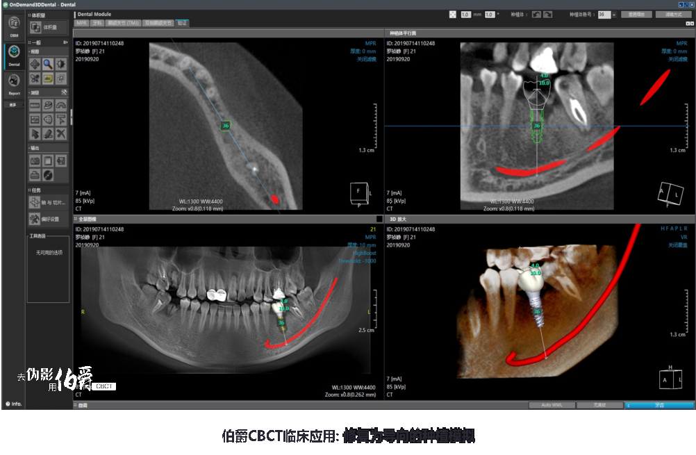 伯爵CBCT