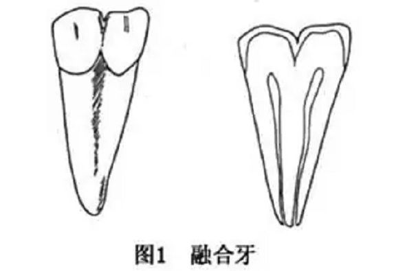 雙牙畸形