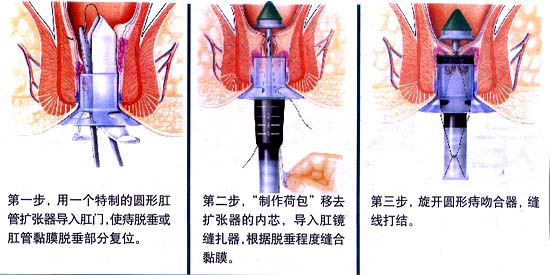 痔瘡pph手術