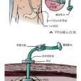 經皮內鏡引導下胃造口術