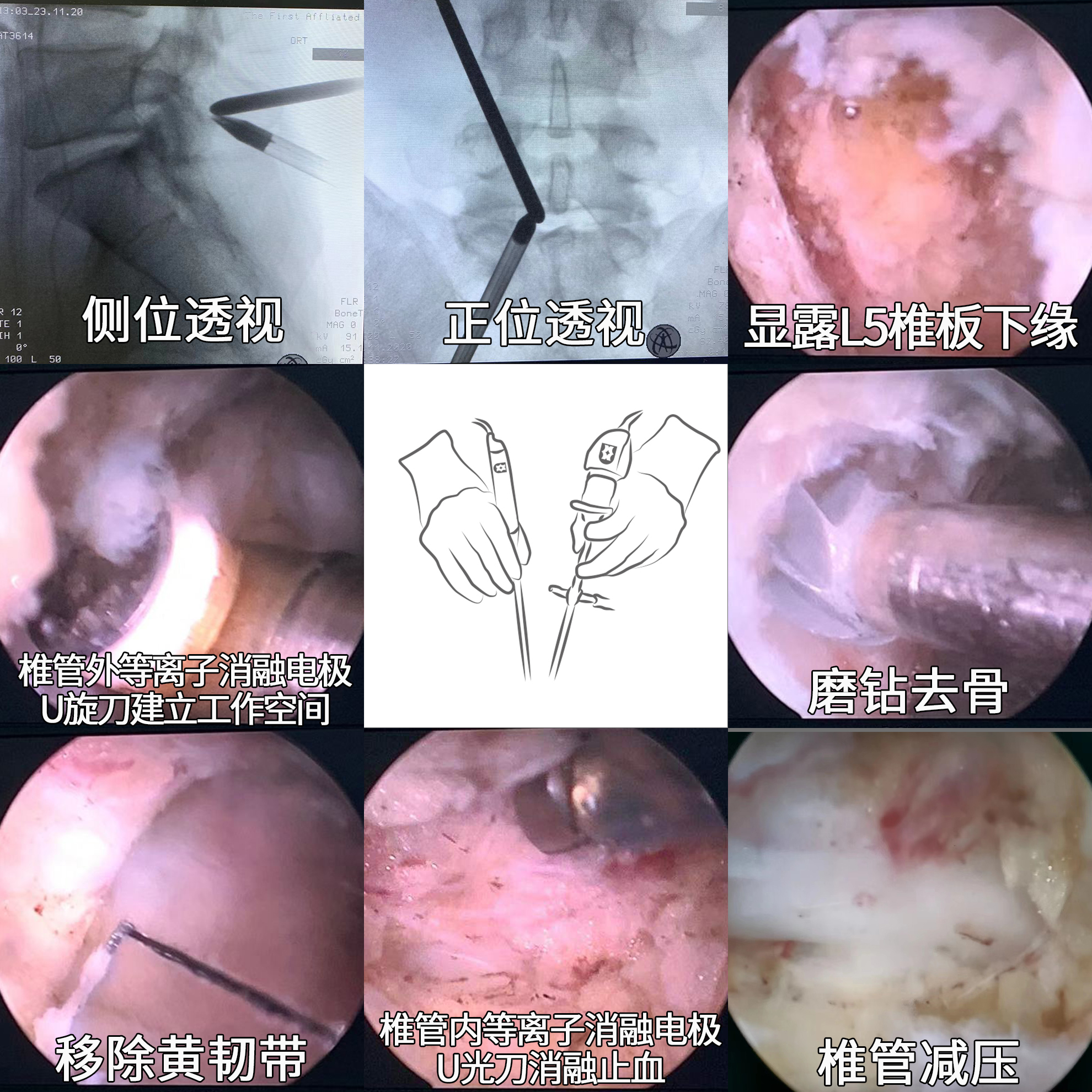 單側雙通道內鏡技術