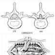 腰椎管、根管擴大減壓術