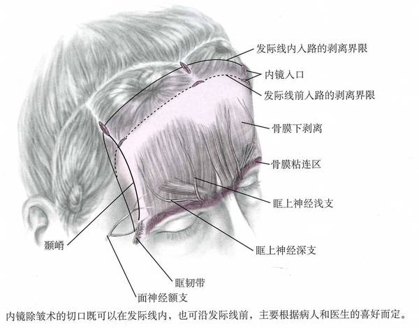 內窺鏡除皺術