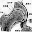 激素型股骨頭壞死