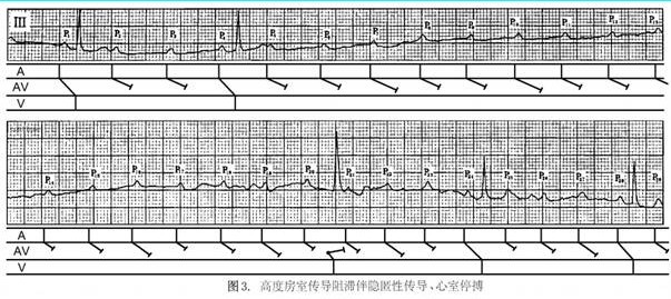 圖2房室阻滯伴隱匿性傳導