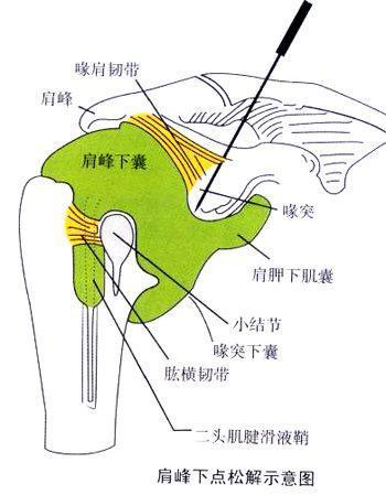 綠色微創雷射針刀松解術