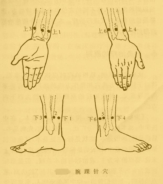 腕踝針法