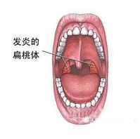 發炎的扁桃體