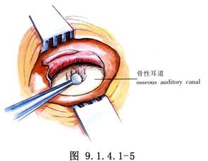 外耳道良性腫瘤切除術