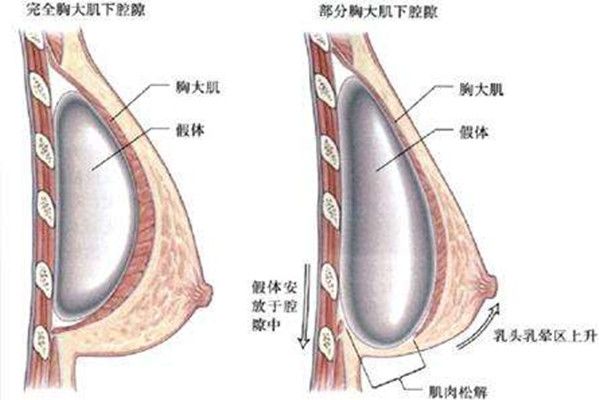 雙平面豐胸