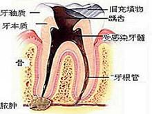 頜骨骨髓炎