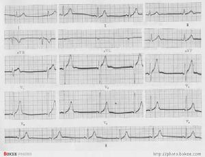 心率失常心電圖