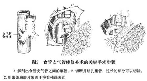 食管中段憩室