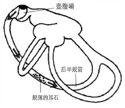 耳石功能不對稱假說