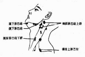 慢性頸淋巴結炎