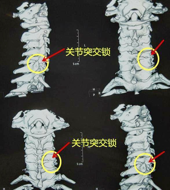 頸椎不穩