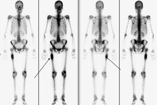 全身骨掃描