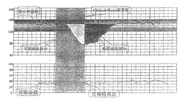 圖2胎心監護曲線圖形面積分析法圖示1