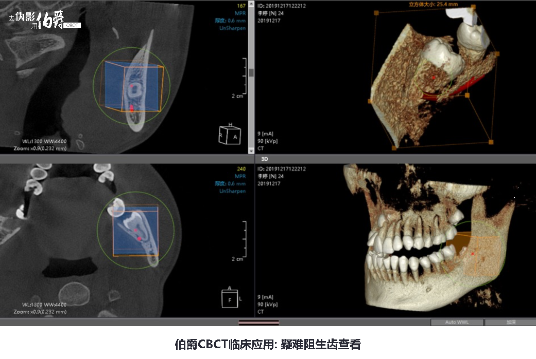 伯爵CBCT