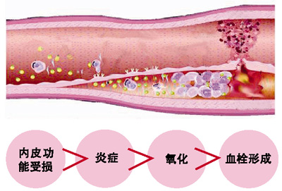 血管硬化