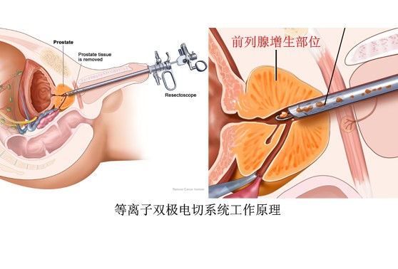 90Sr-90Y治療前列腺增生症