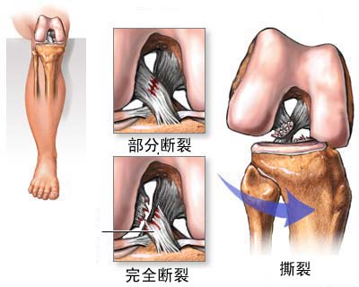 韌帶拉傷的類型