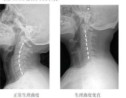 頸椎生理曲線