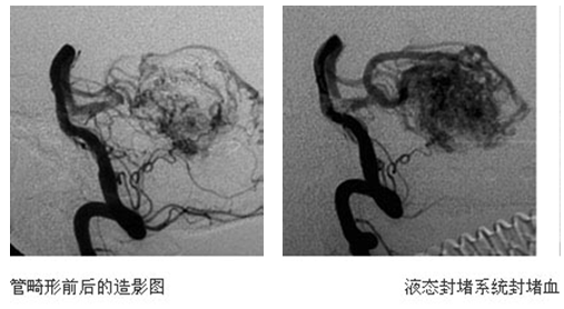 腦血管栓塞