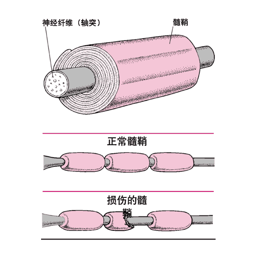 多發性外周神經炎