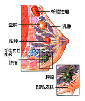 乳腺癌早期症狀