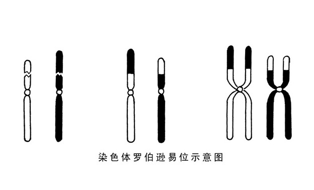 常染色體畸變