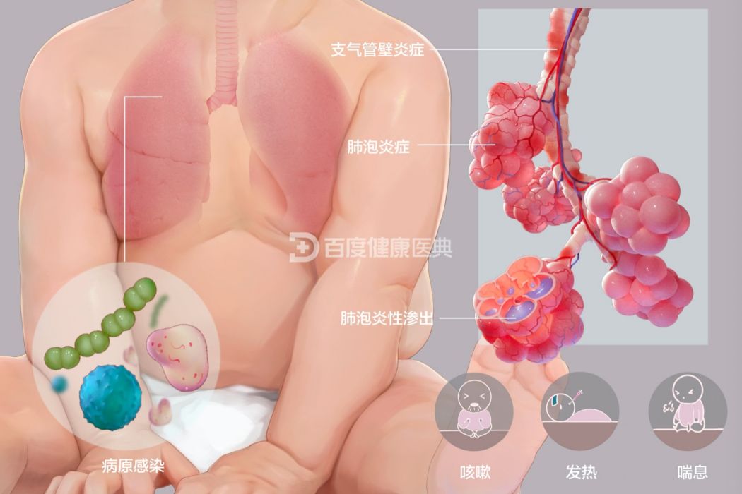 嬰兒支氣管肺炎