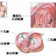 主動脈弓置換術