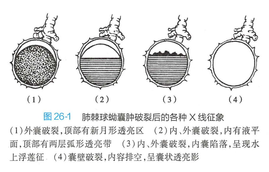 肺棘球蚴囊腫摘除術