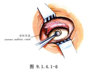 外耳道良性腫瘤切除術