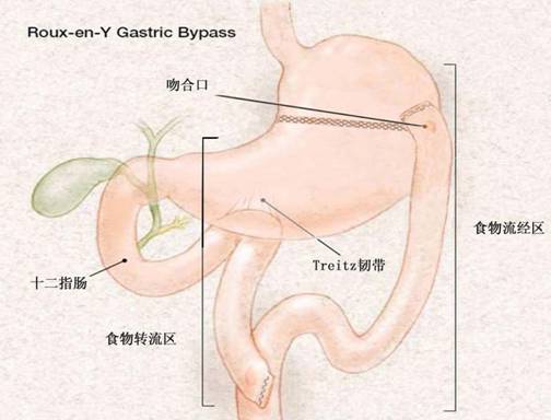 胃轉流手術